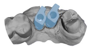 Scanbody vicini